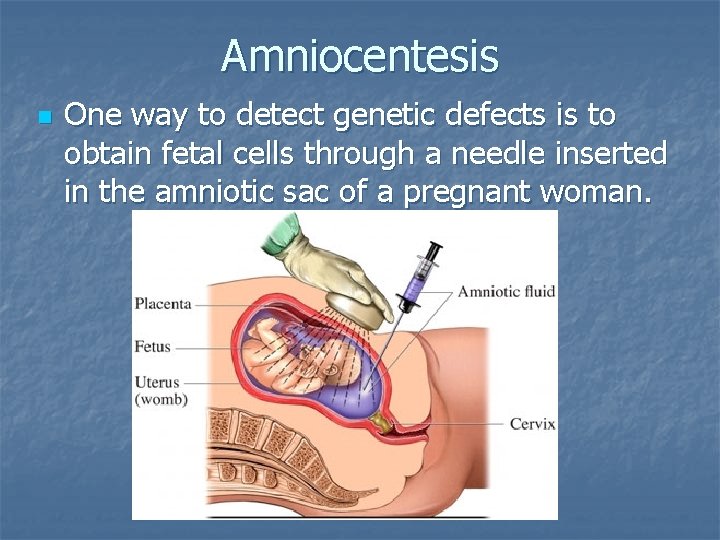 Amniocentesis n One way to detect genetic defects is to obtain fetal cells through