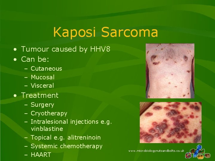 Kaposi Sarcoma • Tumour caused by HHV 8 • Can be: – Cutaneous –