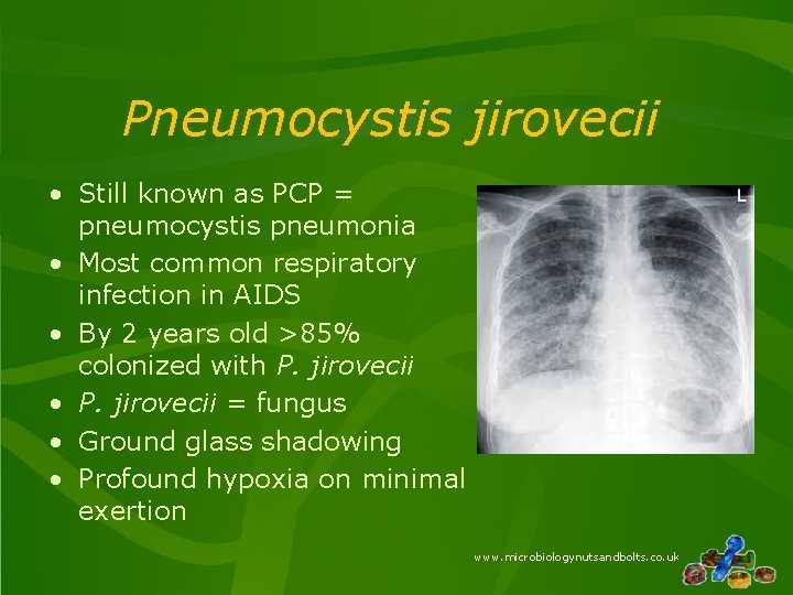 Pneumocystis jirovecii • Still known as PCP = pneumocystis pneumonia • Most common respiratory