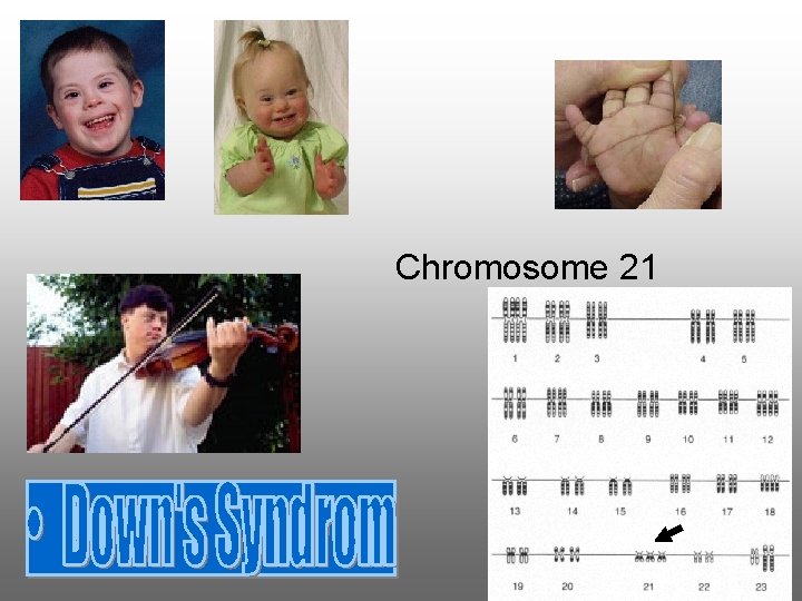 Chromosome 21 Chromosome 21