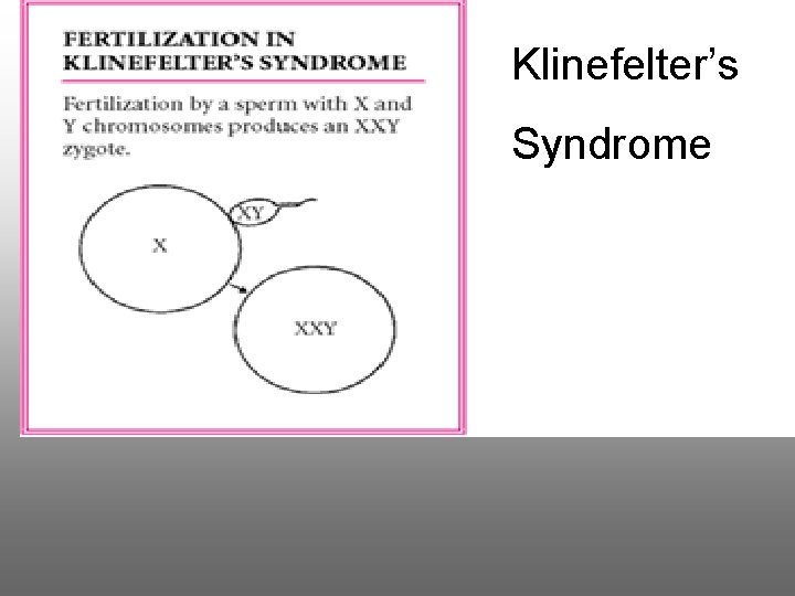 Klinefelter’s Syndrome 