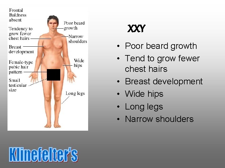 XXY • Poor beard growth • Tend to grow fewer chest hairs • Breast