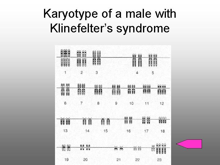 Karyotype of a male with Klinefelter’s syndrome 