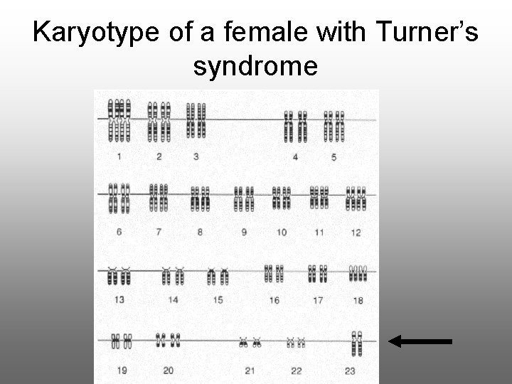 Karyotype of a female with Turner’s syndrome 