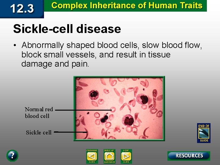 Sickle-cell disease • Abnormally shaped blood cells, slow blood flow, block small vessels, and Sickle-cell disease • Abnormally shaped blood cells, slow blood flow, block small vessels, and