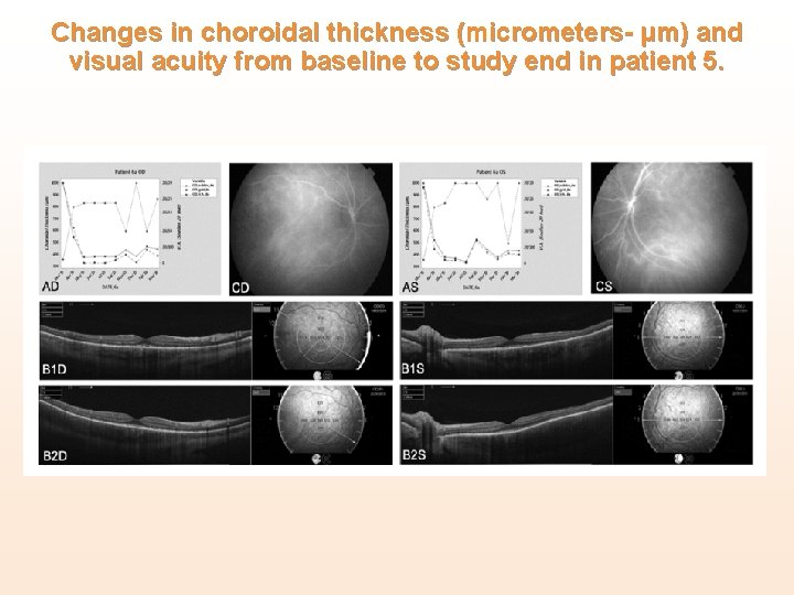 Changes in choroidal thickness (micrometers- μm) and visual acuity from baseline to study end Changes in choroidal thickness (micrometers- μm) and visual acuity from baseline to study end
