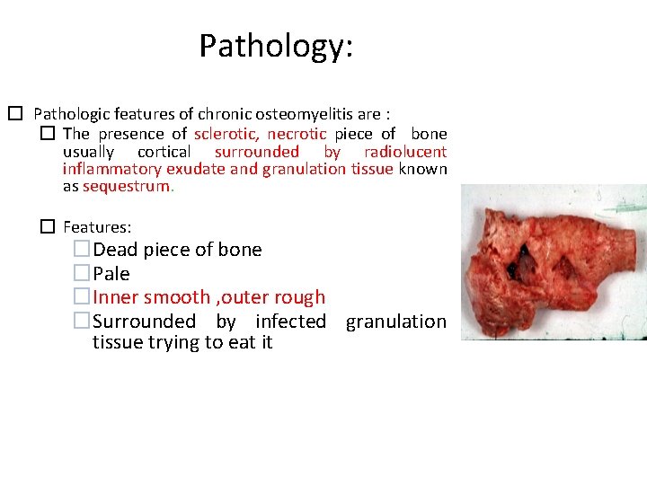 Pathology: � Pathologic features of chronic osteomyelitis are : � The presence of sclerotic,