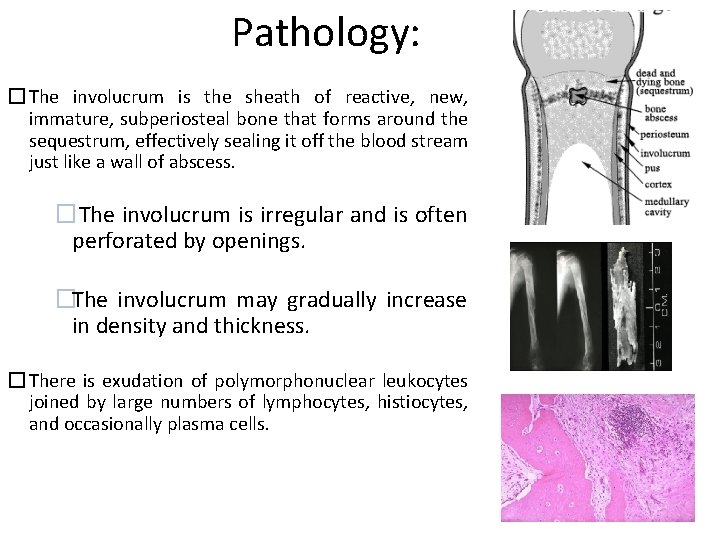 Pathology: � The involucrum is the sheath of reactive, new, immature, subperiosteal bone that