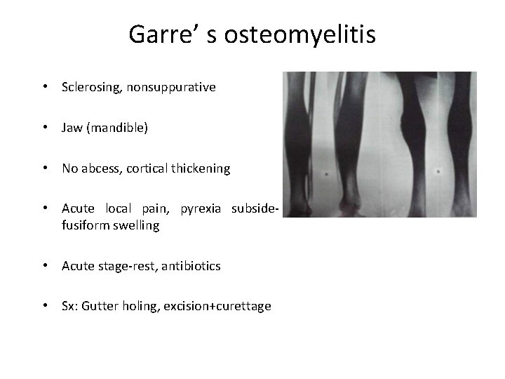 Garre’ s osteomyelitis • Sclerosing, nonsuppurative • Jaw (mandible) • No abcess, cortical thickening