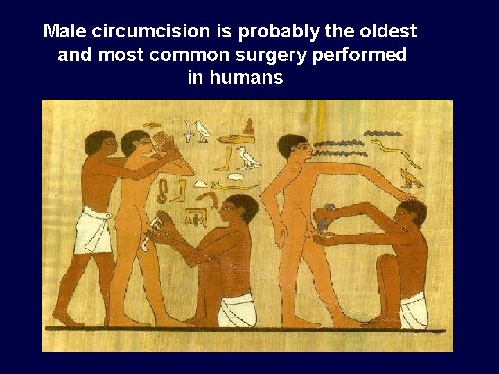 Male circumcision is probably the oldest and most common surgery performed in humans 