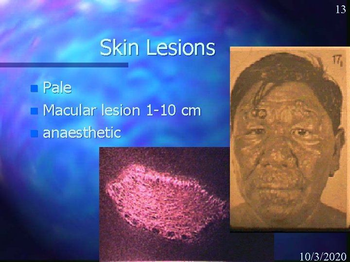 13 Skin Lesions Pale n Macular lesion 1 -10 cm n anaesthetic n 10/3/2020