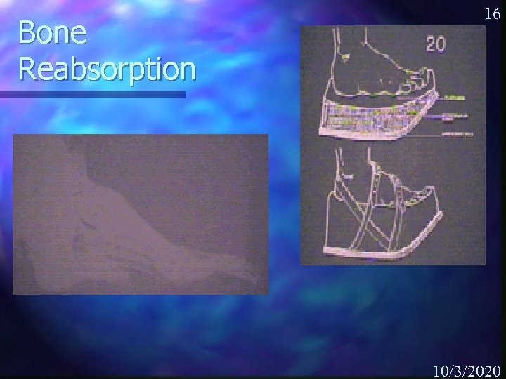 Bone Reabsorption 16 10/3/2020 