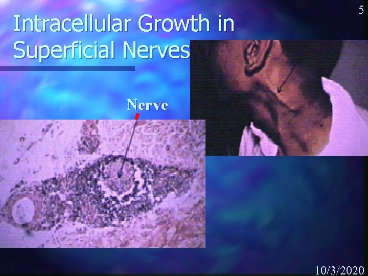 Intracellular Growth in Superficial Nerves 5 Nerve 10/3/2020 
