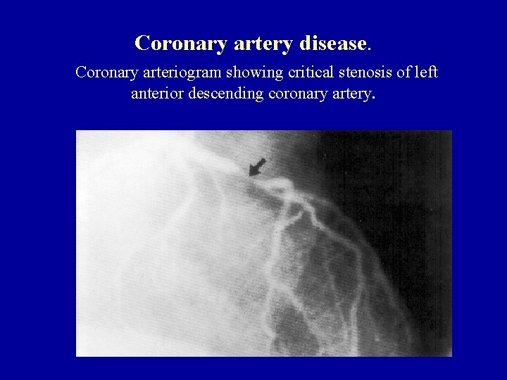 Coronary artery disease. Coronary arteriogram showing critical stenosis of left anterior descending coronary artery.