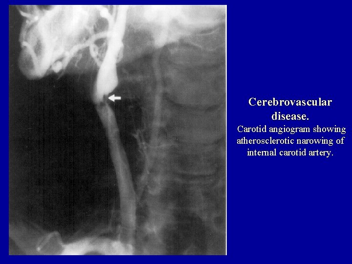 Cerebrovascular disease. Carotid angiogram showing atherosclerotic narowing of internal carotid artery. 