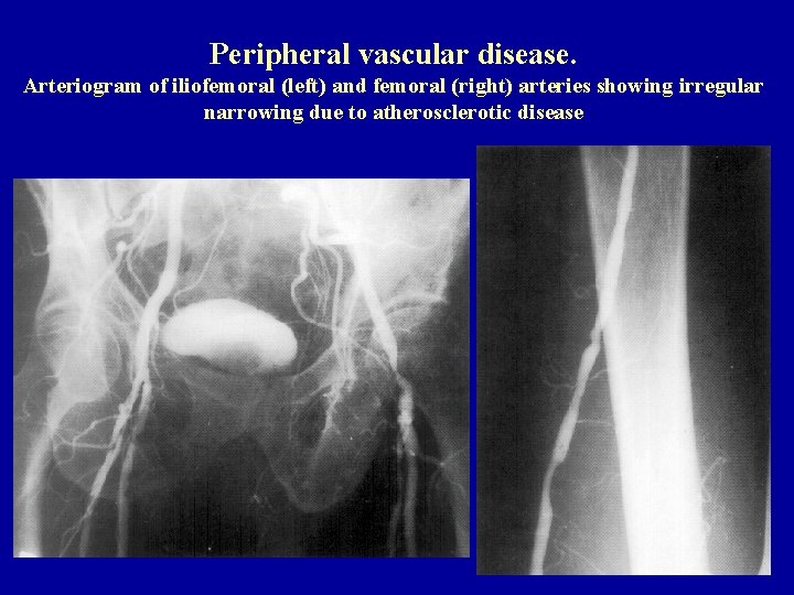 Peripheral vascular disease. Arteriogram of iliofemoral (left) and femoral (right) arteries showing irregular narrowing