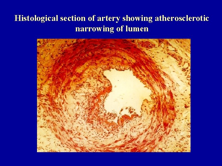 Histological section of artery showing atherosclerotic narrowing of lumen 