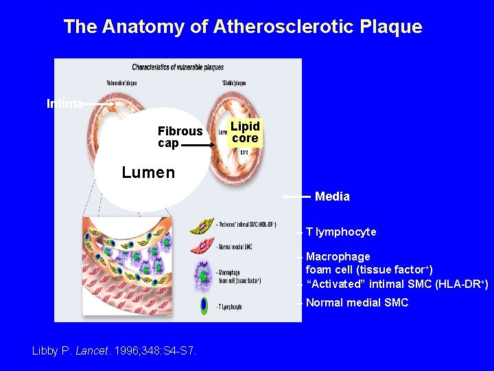 The Anatomy of Atherosclerotic Plaque Intima Fibrous cap Lipid core Lumen Media – T