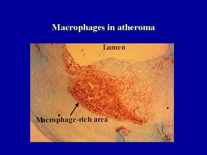 Macrophages in atheroma 