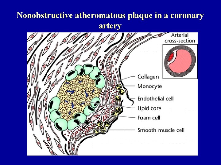 Nonobstructive atheromatous plaque in a coronary artery 