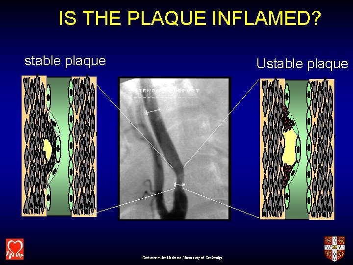 IS THE PLAQUE INFLAMED? stable plaque Ustable plaque Cardiovascular Medicine, University of Cambridge 