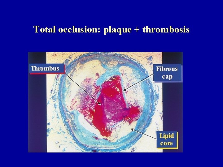 Total occlusion: plaque + thrombosis 