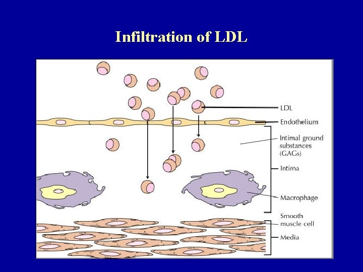 Infiltration of LDL 