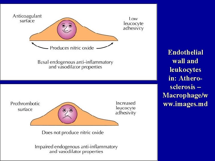 Endothelial wall and leukocytes in: Atherosclerosis – Macrophage/w ww. images. md 