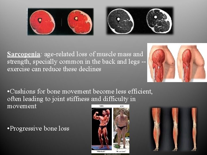 Sarcopenia: age-related loss of muscle mass and strength, specially common in the back and