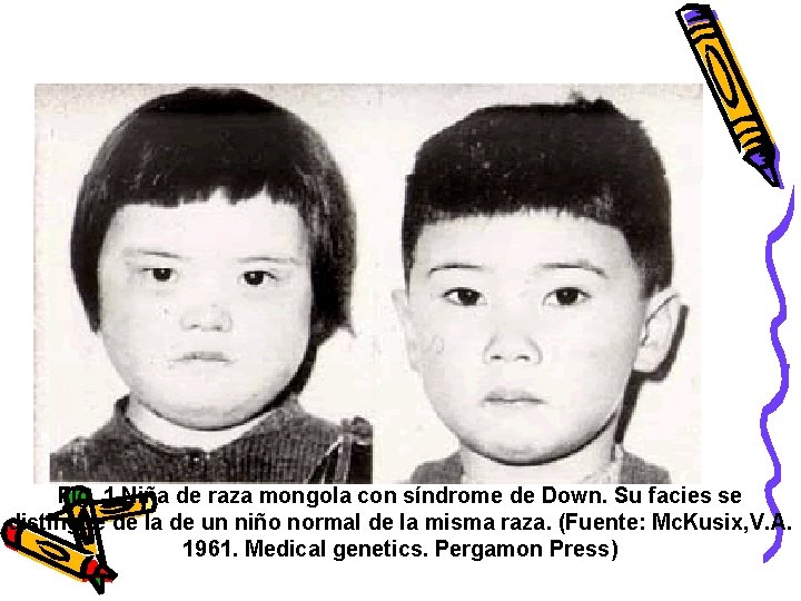  Fig. 1 Niña de raza mongola con síndrome de Down. Su facies se