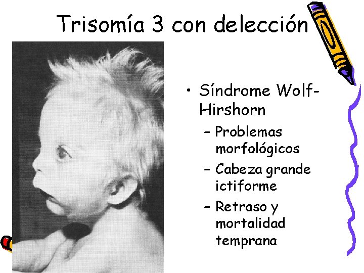 Trisomía 3 con delección • Síndrome Wolf. Hirshorn – Problemas morfológicos – Cabeza grande
