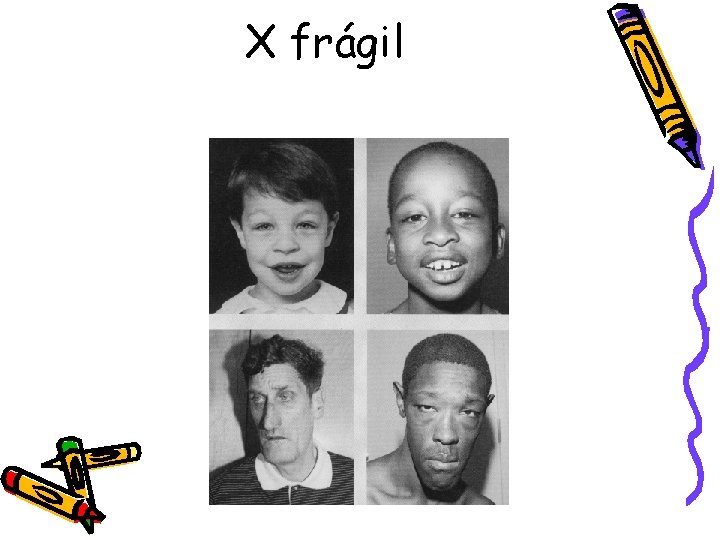 X frágil 