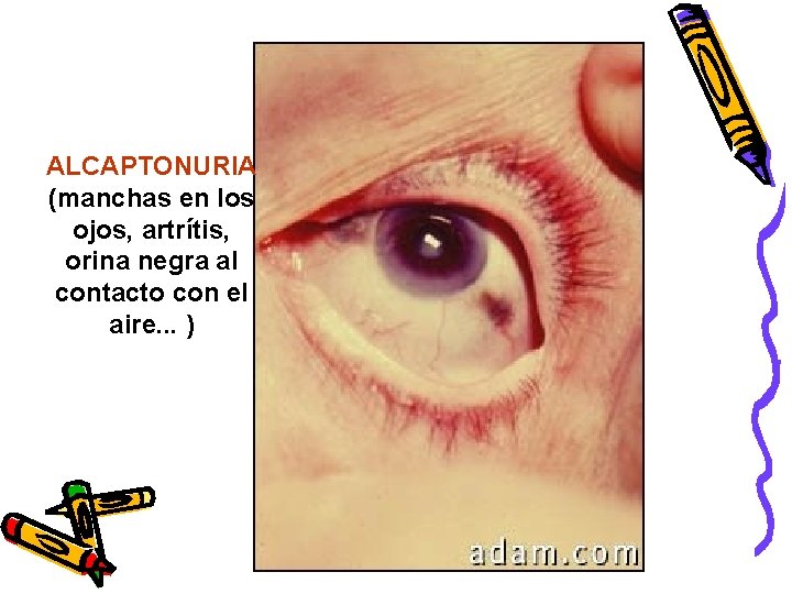 ALCAPTONURIA (manchas en los ojos, artrítis, orina negra al contacto con el aire. .