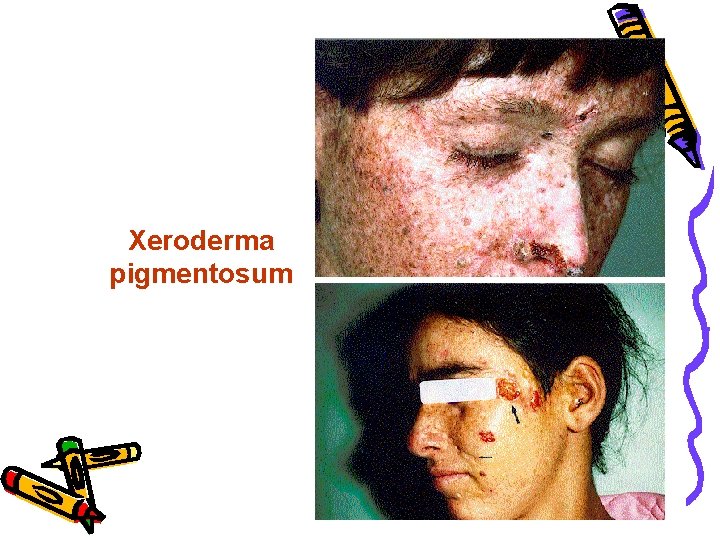Xeroderma pigmentosum 