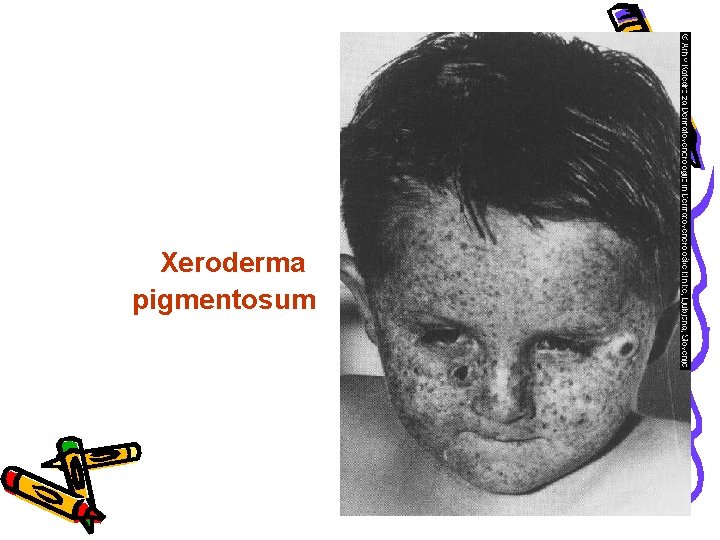 Xeroderma pigmentosum 