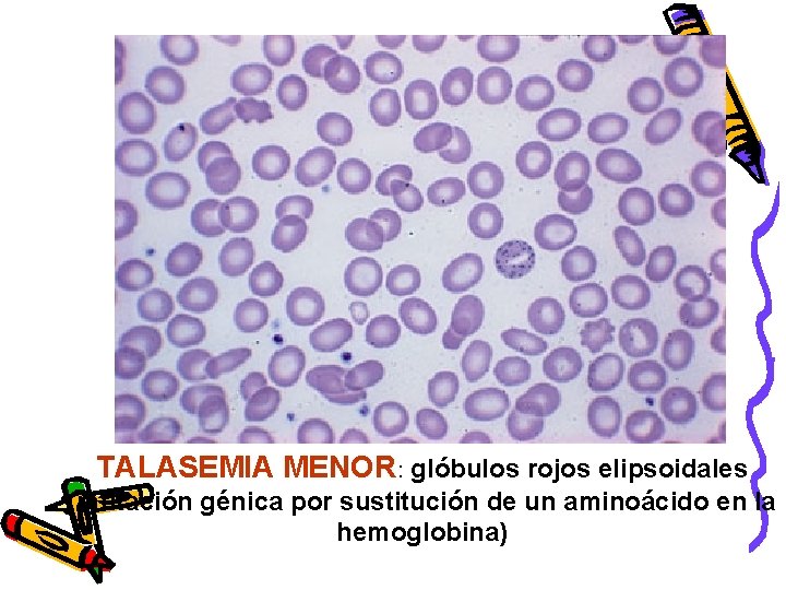 TALASEMIA MENOR: glóbulos rojos elipsoidales (mutación génica por sustitución de un aminoácido en la