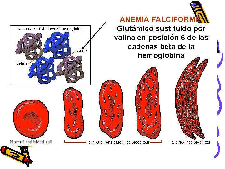 ANEMIA FALCIFORME: Glutámico sustituido por valina en posición 6 de las cadenas beta de