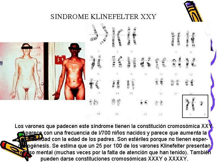 SINDROME KLINEFELTER XXY Los varones que padecen este síndrome tienen la constitución cromosómica XXY.