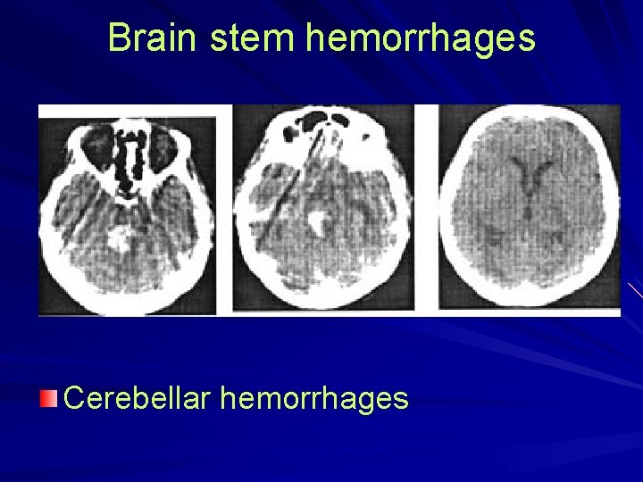 Brain stem hemorrhages Cerebellar hemorrhages 
