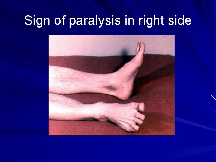 Sign of paralysis in right side 