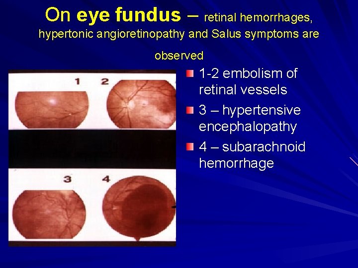 On eye fundus – retinal hemorrhages, hypertonic angioretinopathy and Salus symptoms are observed 1