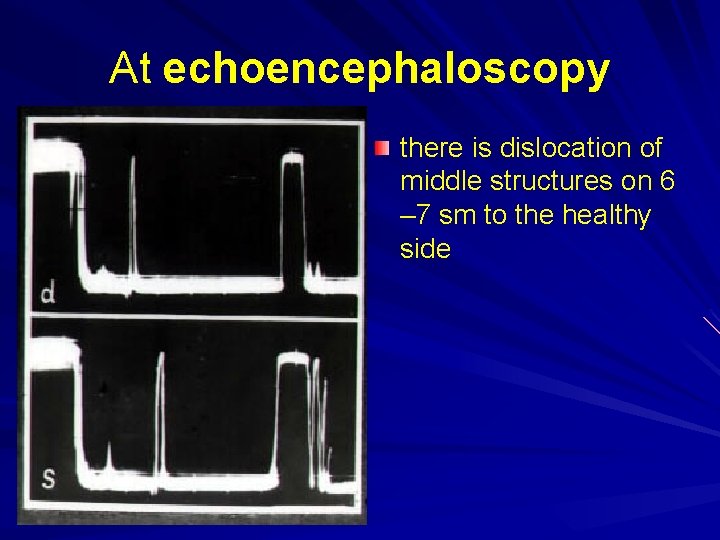 At echoencephaloscopy there is dislocation of middle structures on 6 – 7 sm to