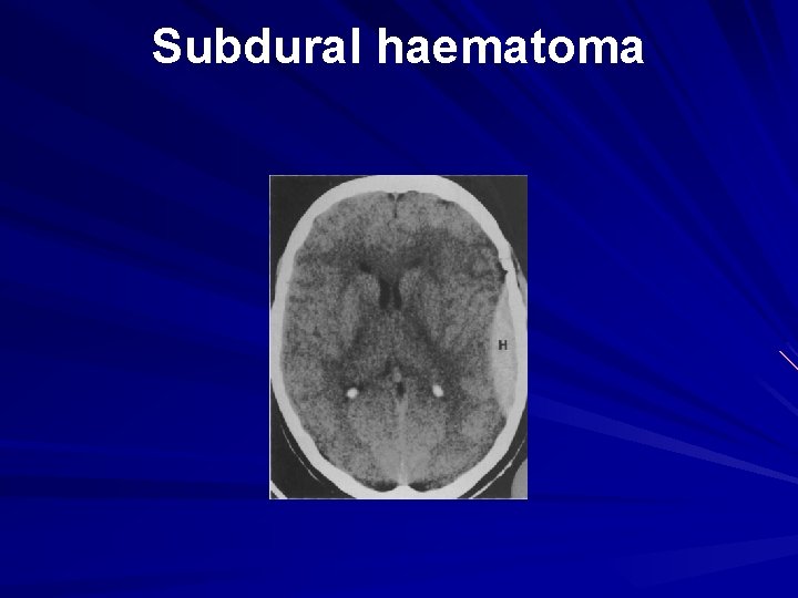 Subdural haematoma 