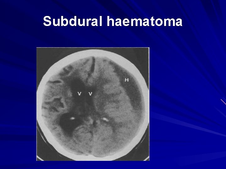 Subdural haematoma 