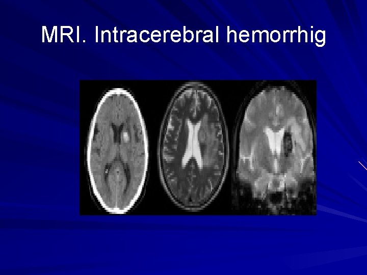 MRI. Intracerebral hemorrhig 