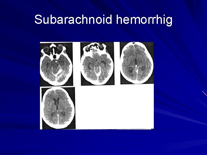 Subarachnoid hemorrhig 