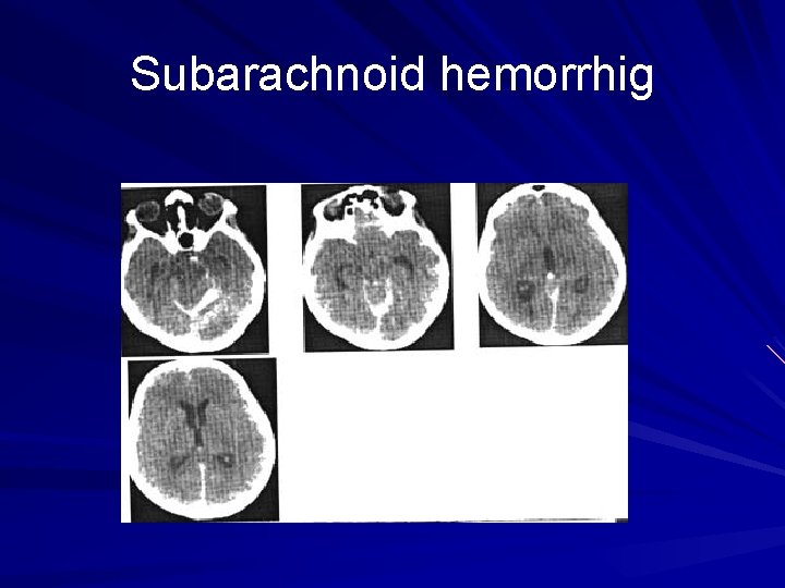 Subarachnoid hemorrhig 