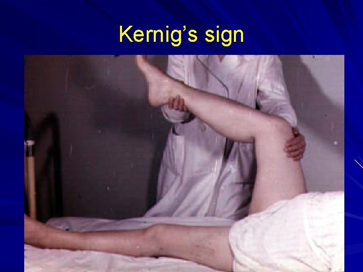 Kernig’s sign 