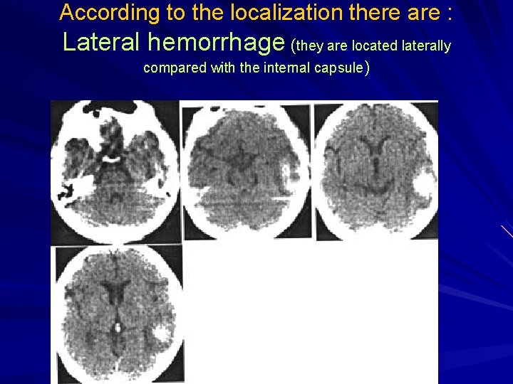 According to the localization there are : Lateral hemorrhage (they are located laterally compared