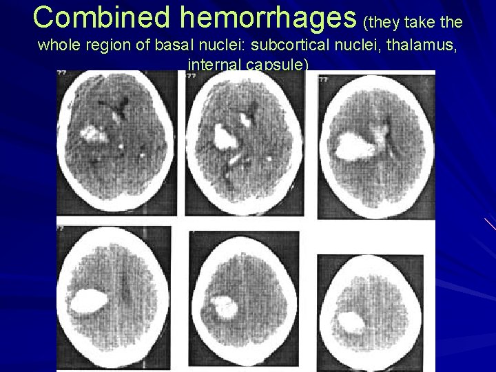 Combined hemorrhages (they take the whole region of basal nuclei: subcortical nuclei, thalamus, internal